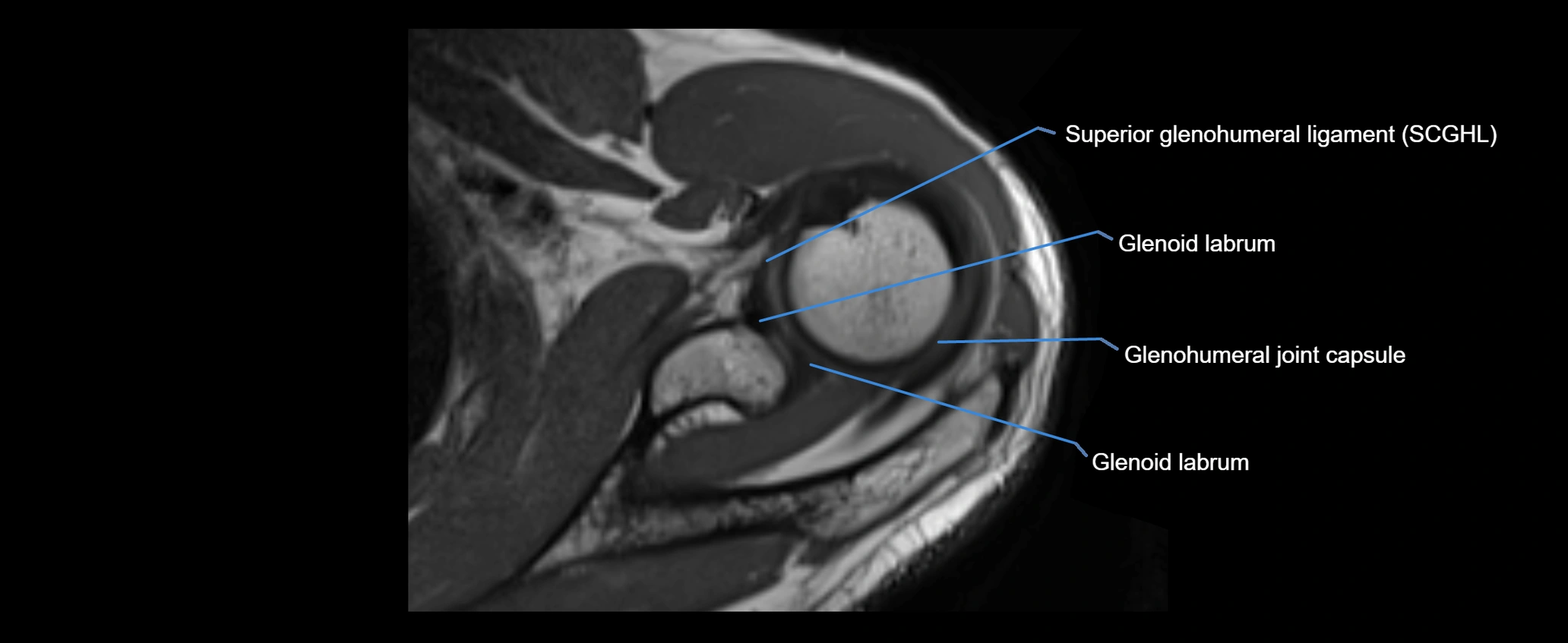 shoulder ligaments axial 3d 3t mri image-img-00005-00048.webp